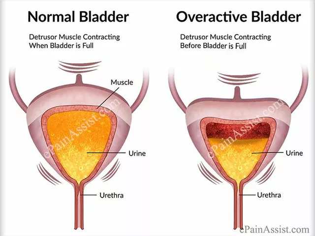 The impact of bladder and urinary incontinence symptoms on exercise and physical activity